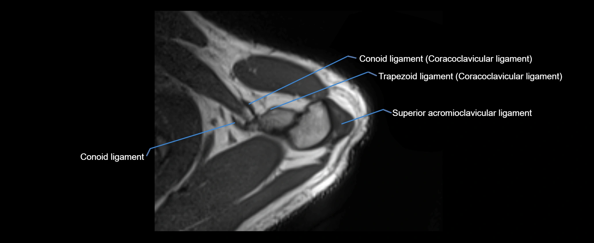 shoulder ligaments axial 3d 3t mri image-img-00005-00023.webp